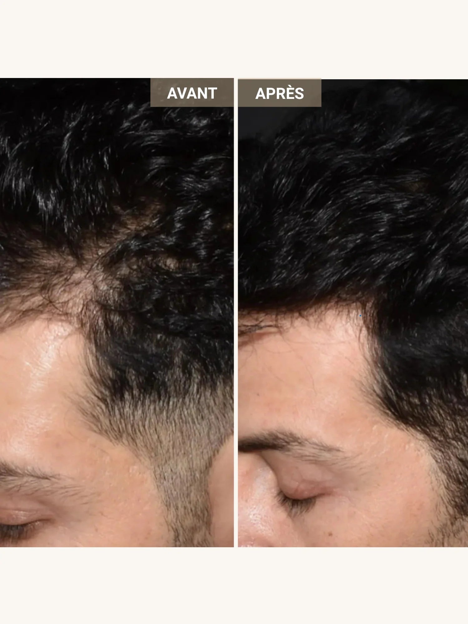 Casque LED & laser cheveux "Le Professionnel"